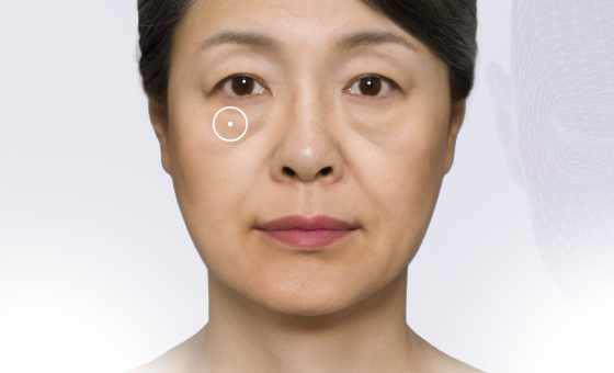 Under-eye Bags
